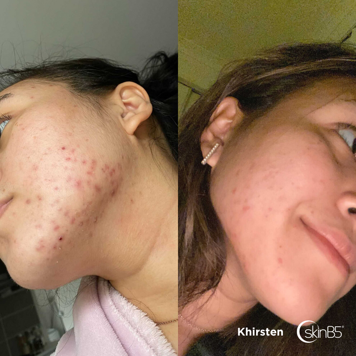 SkinB5™ helped Khirsten to get rid of her severe acne