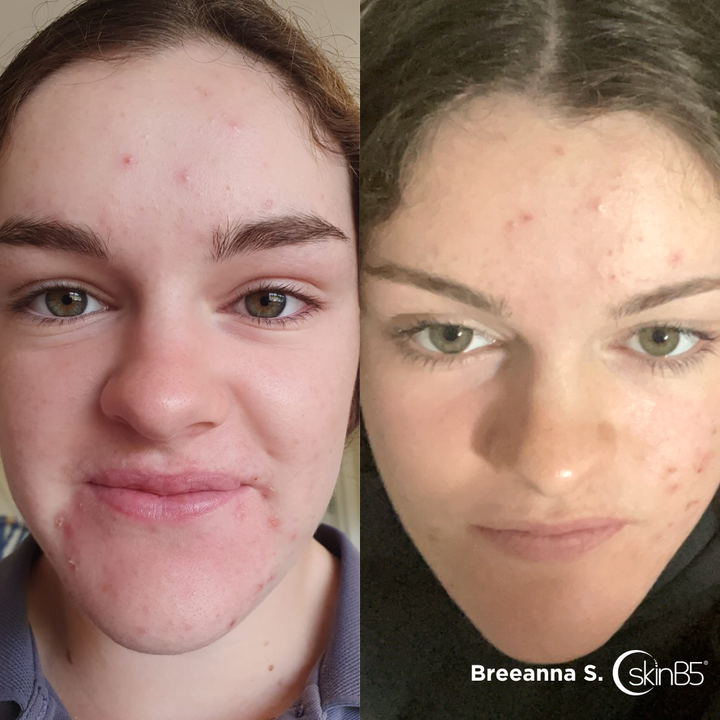 Breeanna regained her confidence by using the SkinB5™ range