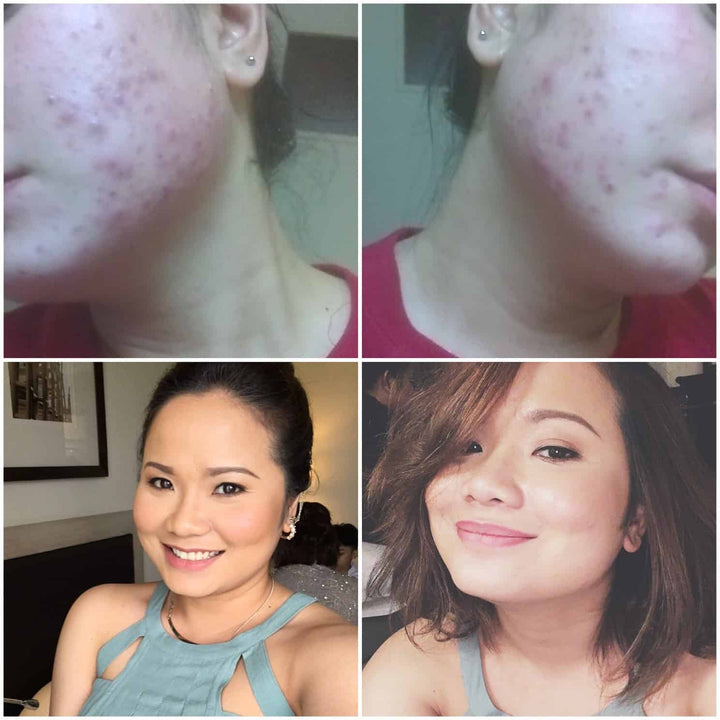 Adult hormonal acne devastated Charlene Palad but skinB5 changed everything