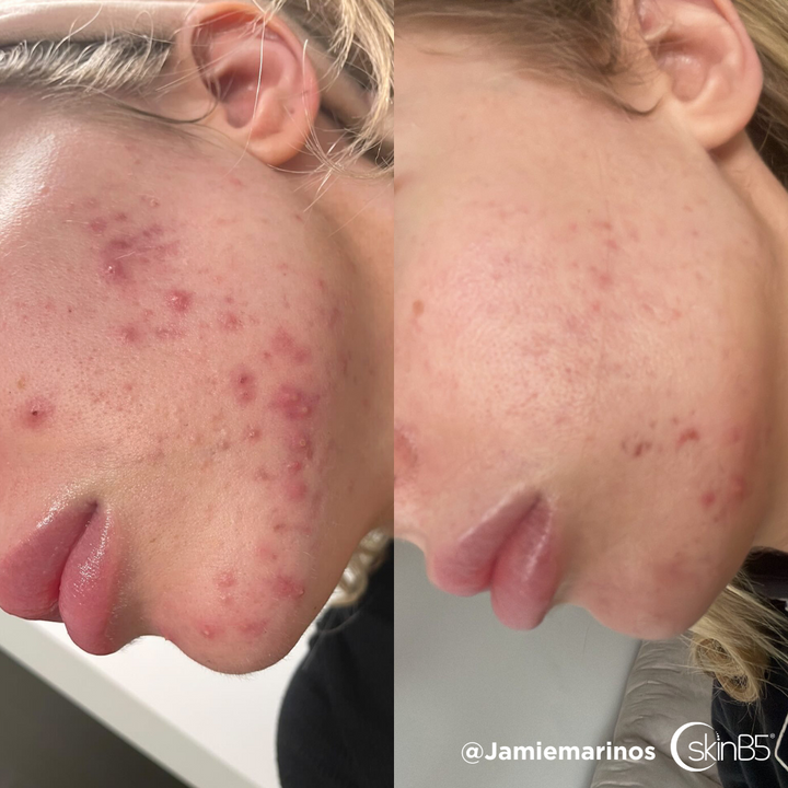 SkinB5™ helped @Jamiemarinos to get rid of her severe acne