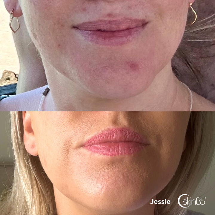 Jessie witnessed a significant improvement in the condition of her skin in merely 4 weeks