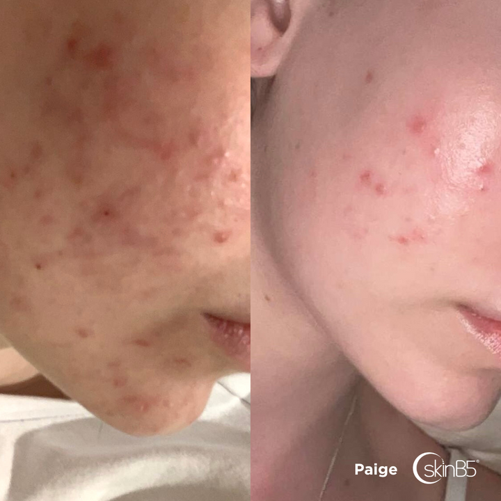 Paige found her skin has significant improvement in just 1 week