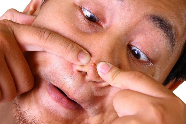 Do you love watching pimple popping? You're not alone