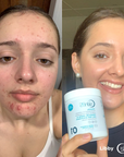 Acne clearing vitamins, collagen, and prebiotics for skin health