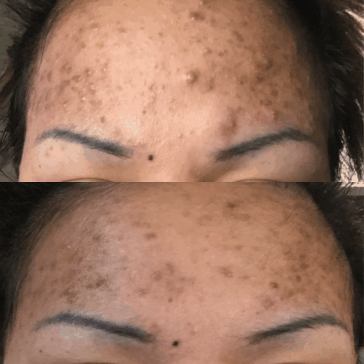 After initial purging Atena Reyed's acne cleared up after one month