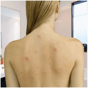 Bacne (Back Acne): Causes and Treatments