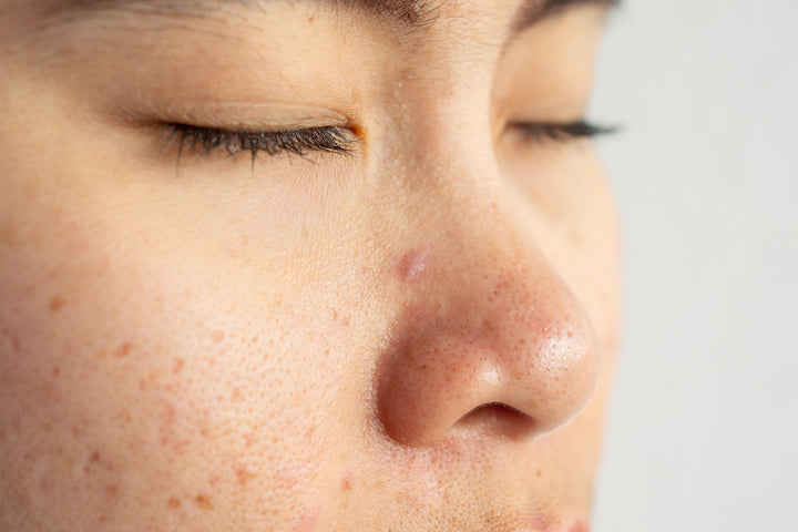 Acne Scars: Prevention and Treatment