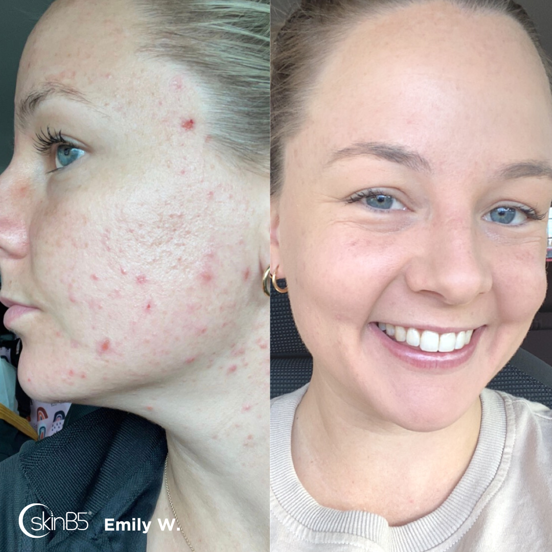 ACNE - Christine Emily Cleared Her Acne Completely in Just 2 Weeks with