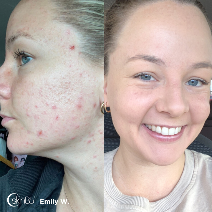 SkinB5™ helped Emily W Completely cleared up her acne in 2 weeks 