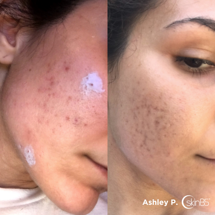 SkinB5™ helped Ashley Prete to get rid of her hormonal acne