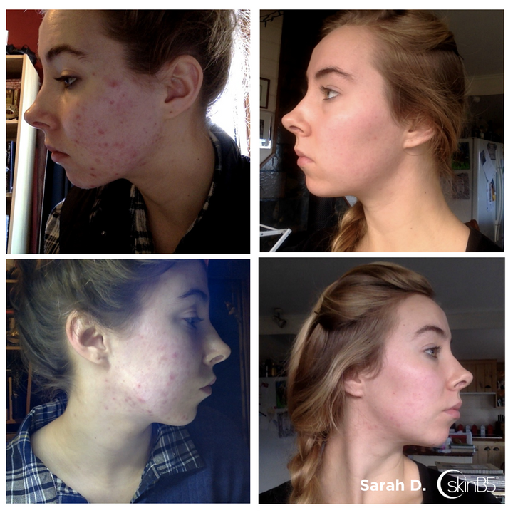 SkinB5 helped Sarah Downes to clear up her hormonal acne