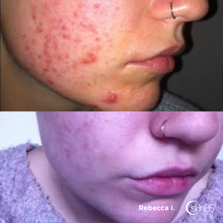 How Rebecca regained confidence after SkinB5™ cleared up her severe acne