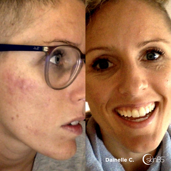 Danielle Connor cleared up her persistent acne by using the skinB5™ range