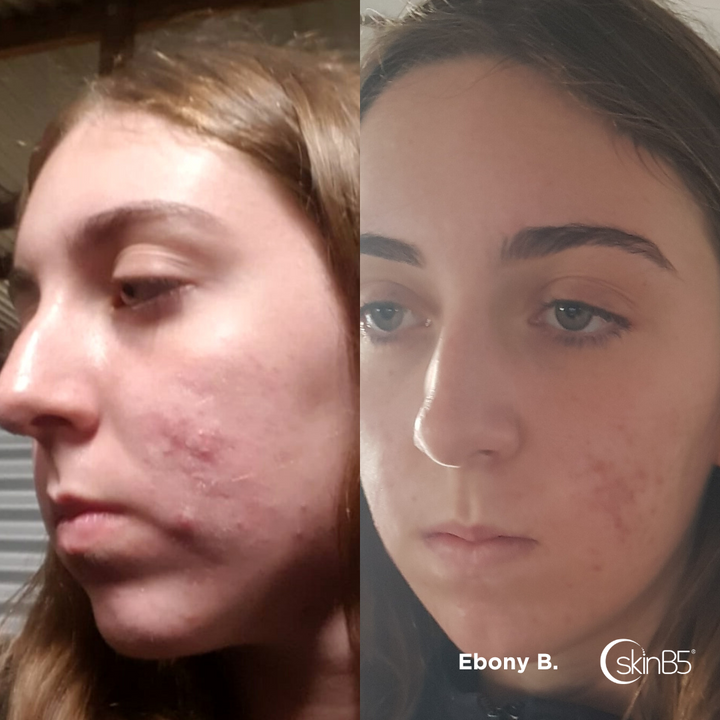 Ebony Butler noticed her skin has dramatically improved in 5 weeks