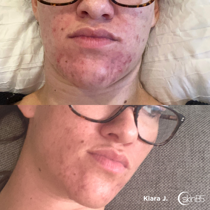 Kiara Johnson noticed her skin has significant improved in just 4 weeks
