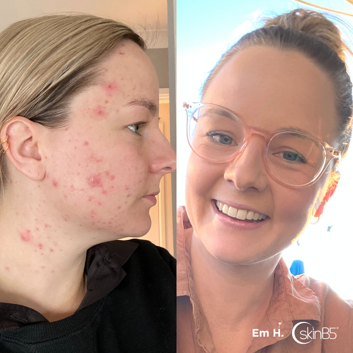 Blog posts SKINB5™ HELPED EM HANNAN COMPLETELY CLEARED UP HER ACNE IN 2 WEEKS