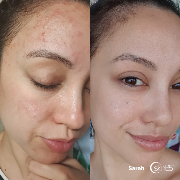 SkinB5™ helped Sarah Completely Cleared Up her Hormonal Acne