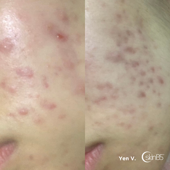 SkinB5™ helped Yen Vu to get rid of her very inflamed acne