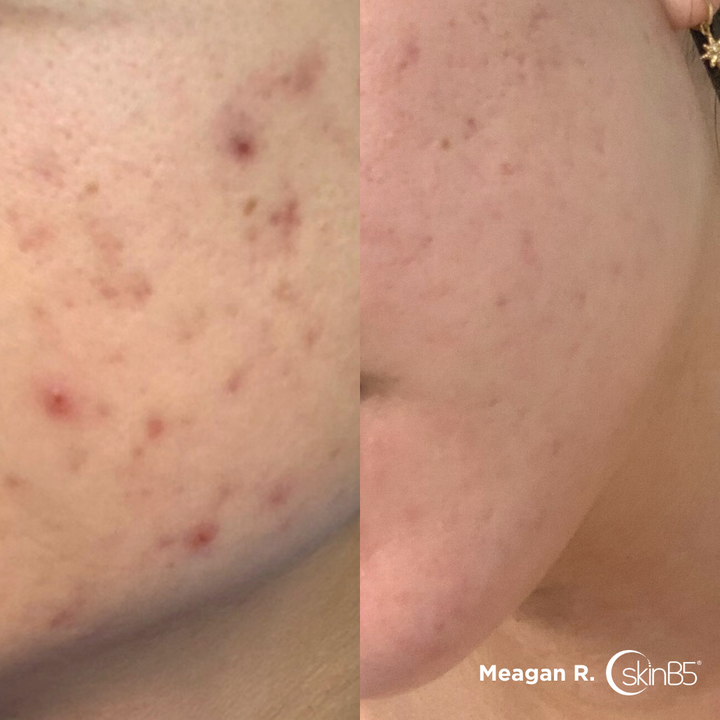 Meagan Roth cleard up her presistent acne by using skinB5™ products