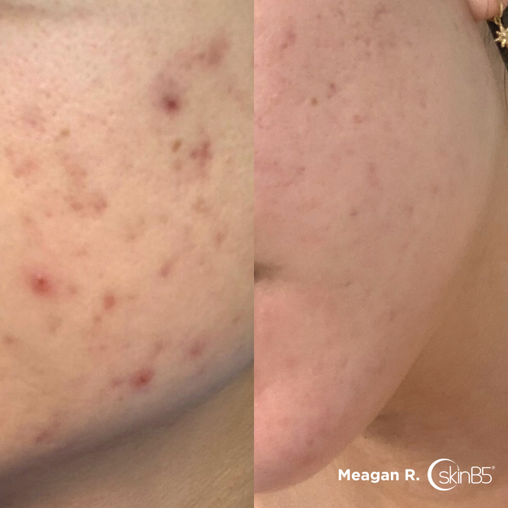 Meagan Roth cleard up her presistent acne by using skinB5™ products ...