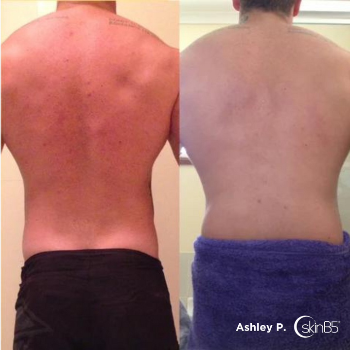 Ashley Pendergast used SkinB5™ products to clear his body acne
