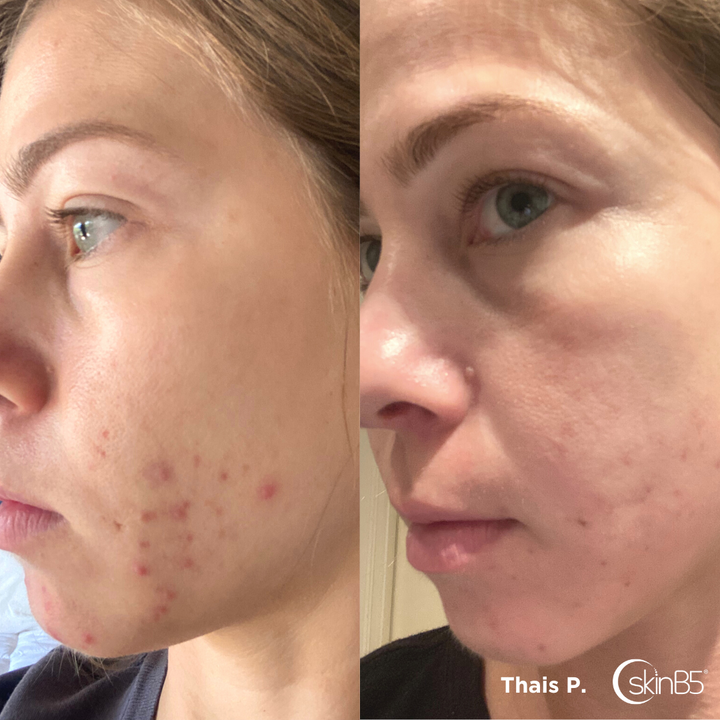 Thais Parreira's skin has remarkable transformation in 2 months