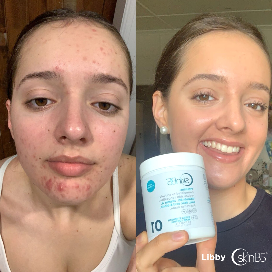Libby Cleared Her Acne Within a Month Thanks to SkinB5