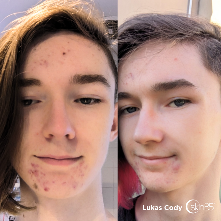 Lukas Cody's skin has massively improved in 4 weeks