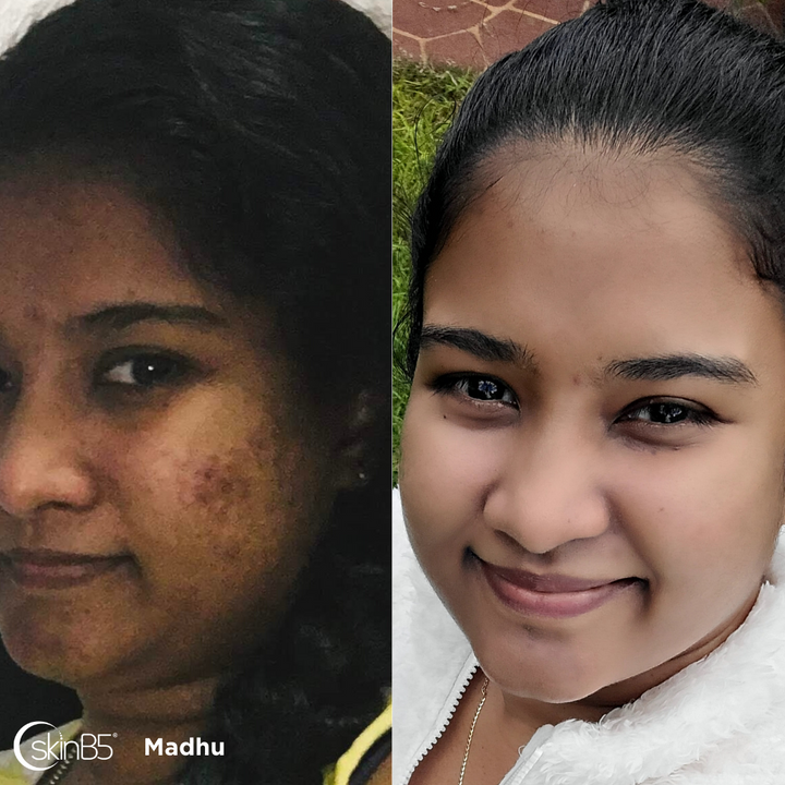 Madhu's skin has significant improvement in just 3 weeks