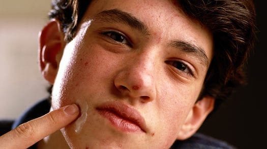 How to Treat Extreme Teenage Acne, Naturally