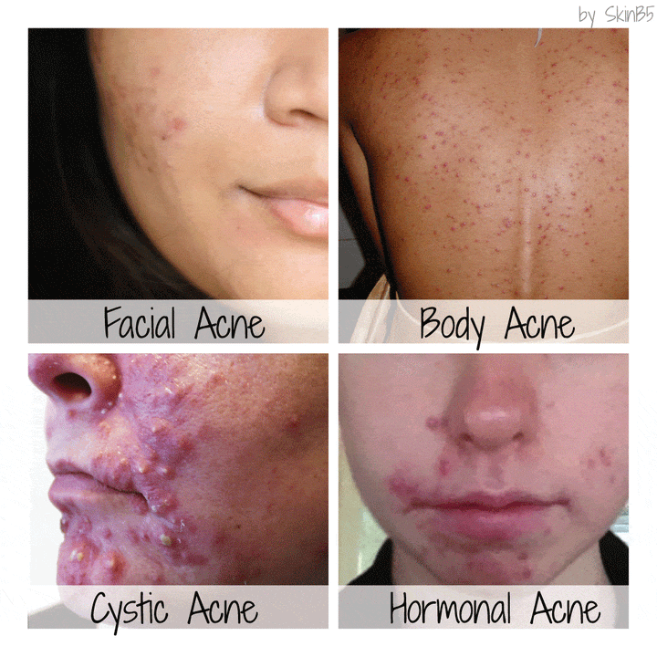 Types of Pimples & How to Treat Them
