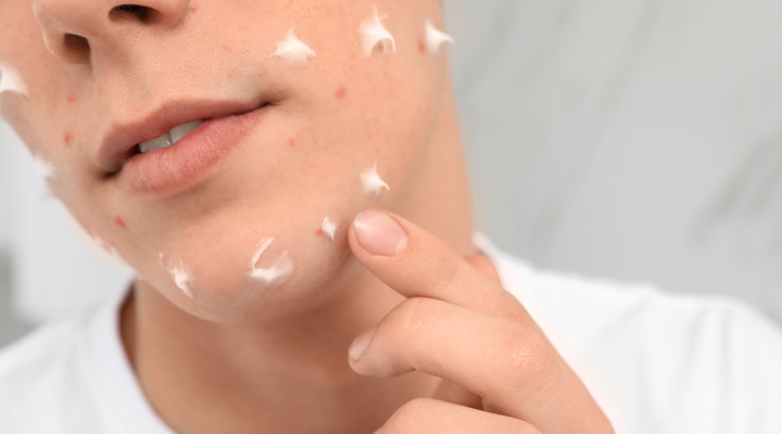 How to Clear Up Teenage Acne Naturally