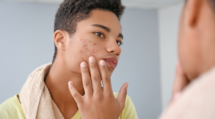 How to Survive Bad Acne
