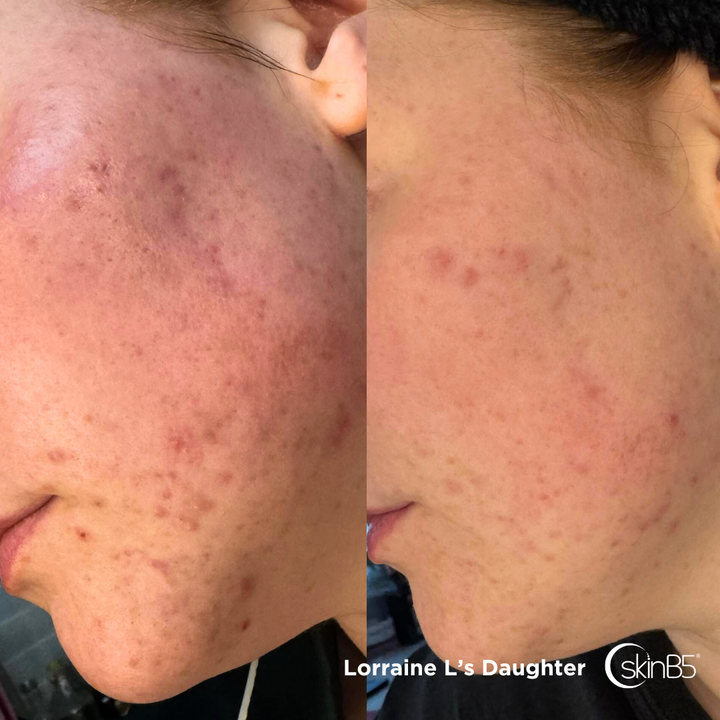 Lorraine Lee noticed her daughter's skin has changed in ONE week