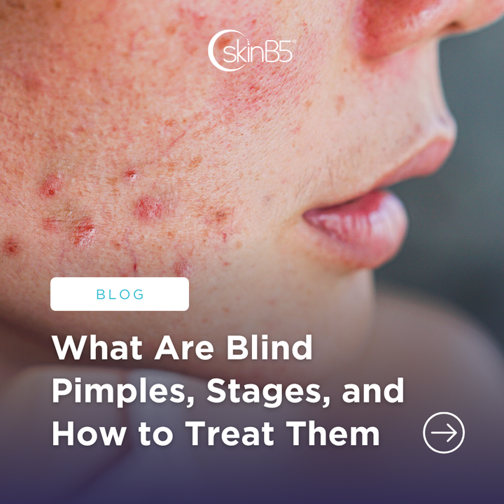 What Are Blind Pimples, Stages, and How to Treat Them