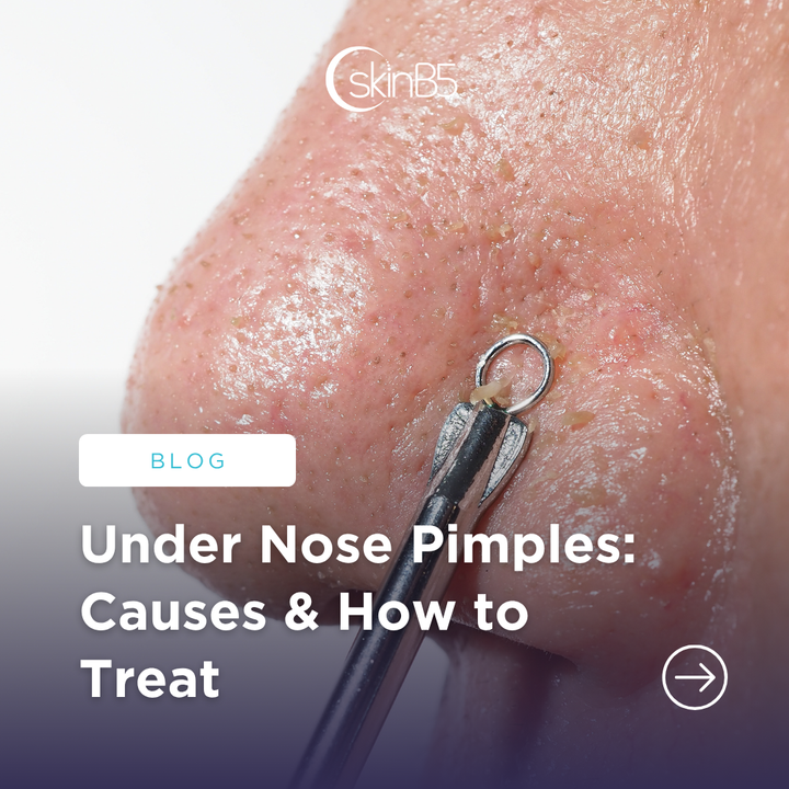 How to Treat Pimples on Nose: Your Ultimate Guide to Clearer Skin How to Treat Pimples on Nose: Your Ultimate Guide to Clearer Skin