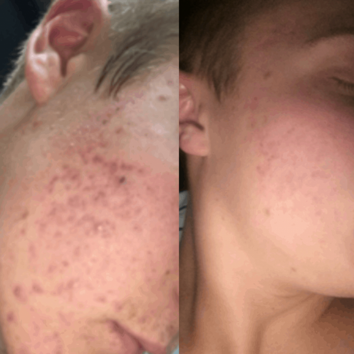 Toby Horne regained confidence to go out after skinB5 cleared up his acne