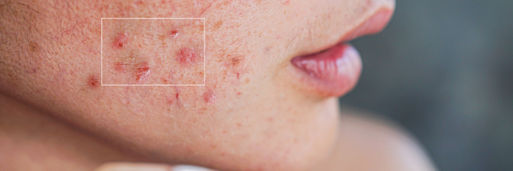 Types of Pimples & How to Treat Them