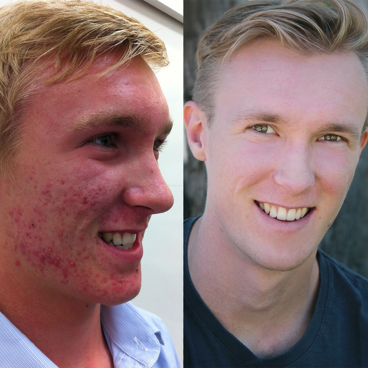 My Journey overcoming teenage acne - Luis Barnett, Australian Actor