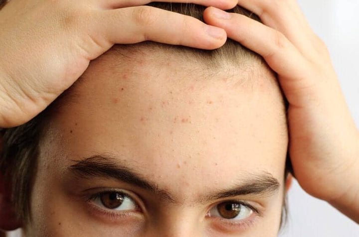 Male Acne: What Causes It?