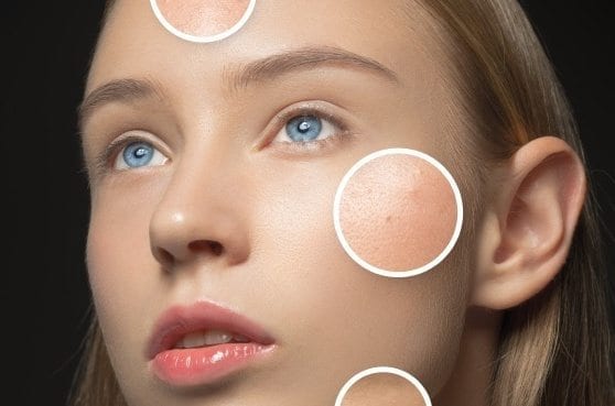 Why does Acne hit the same spot on your face?